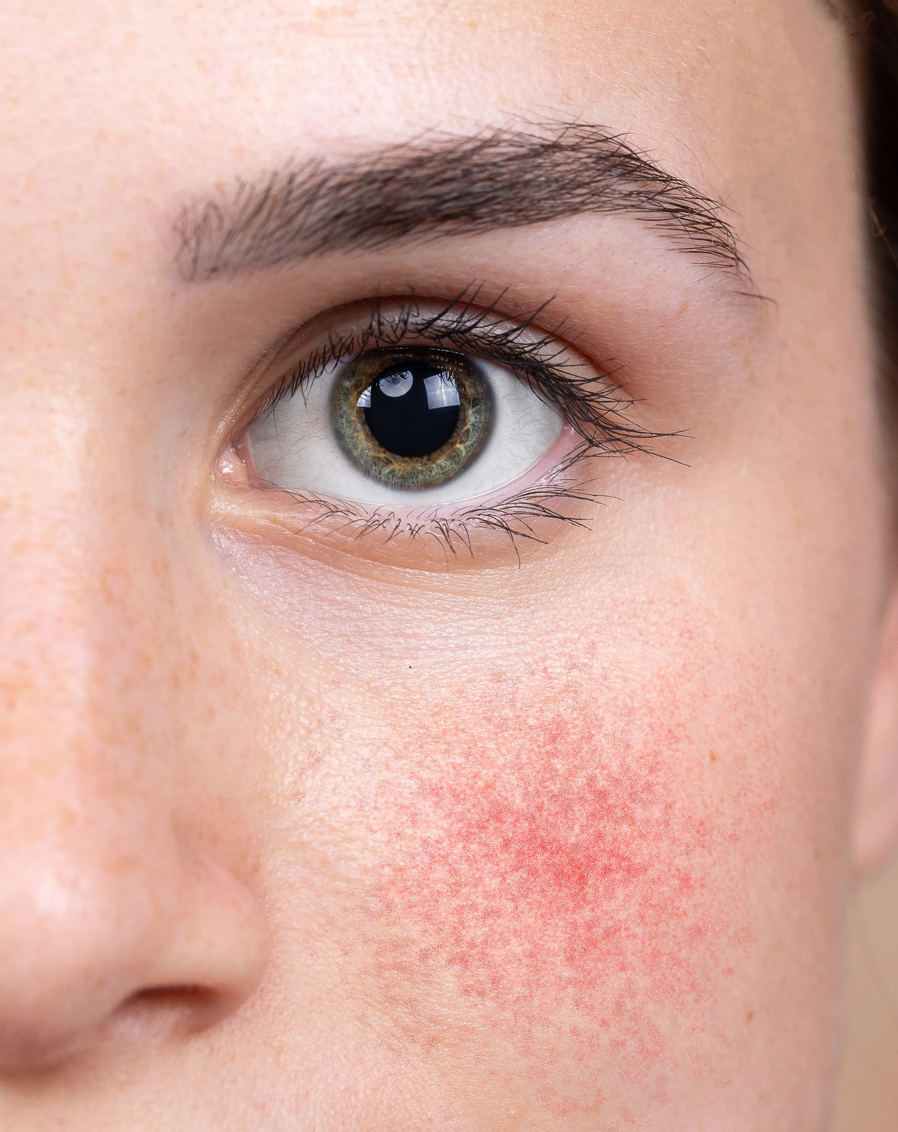 Couperose | aesthetics Pallas Kliniken Couperose