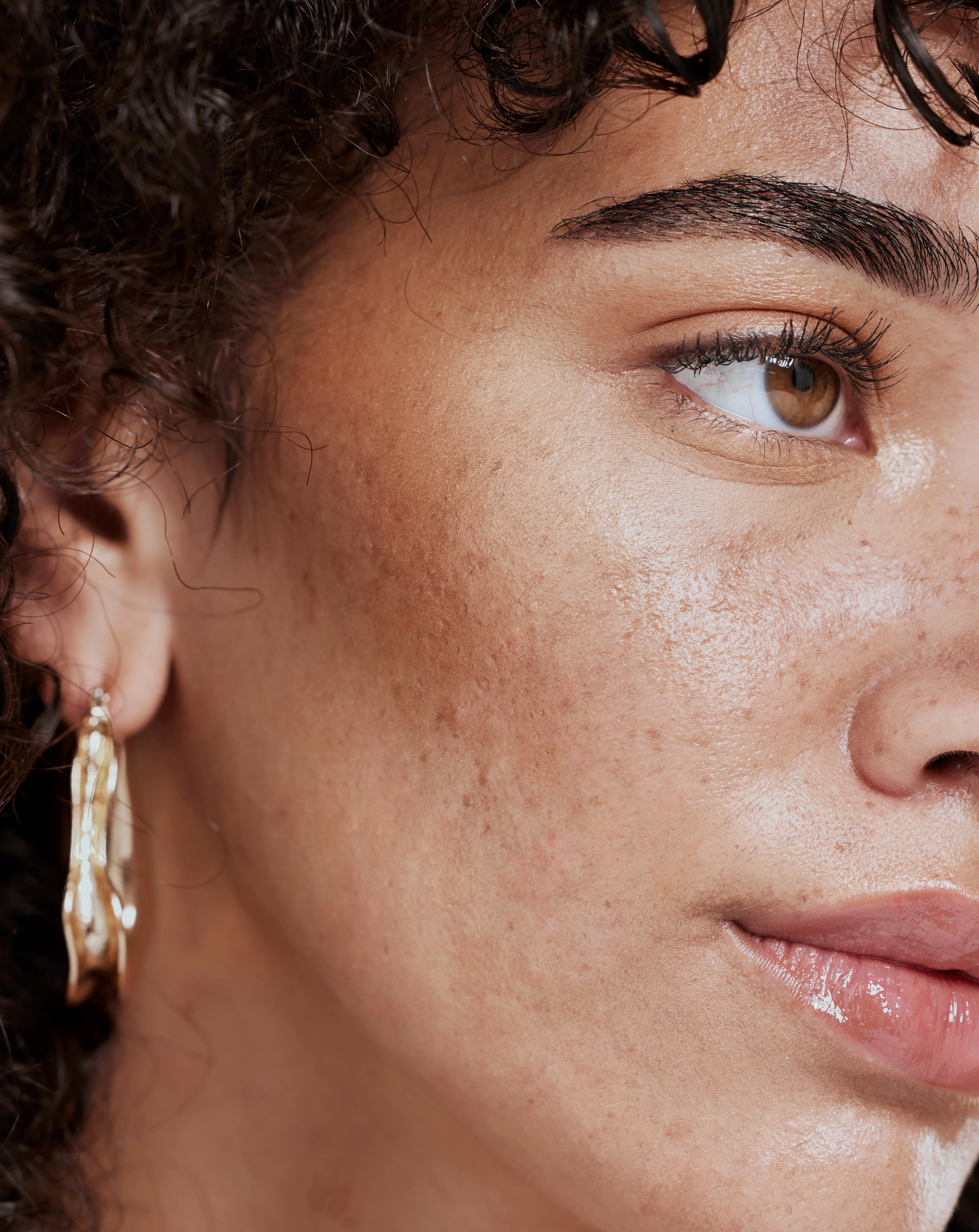 Wangenaufbau mit Hyaluronsäure | aesthetics Pallas Kliniken Wangenaufbau mit Hyaluronsäure
