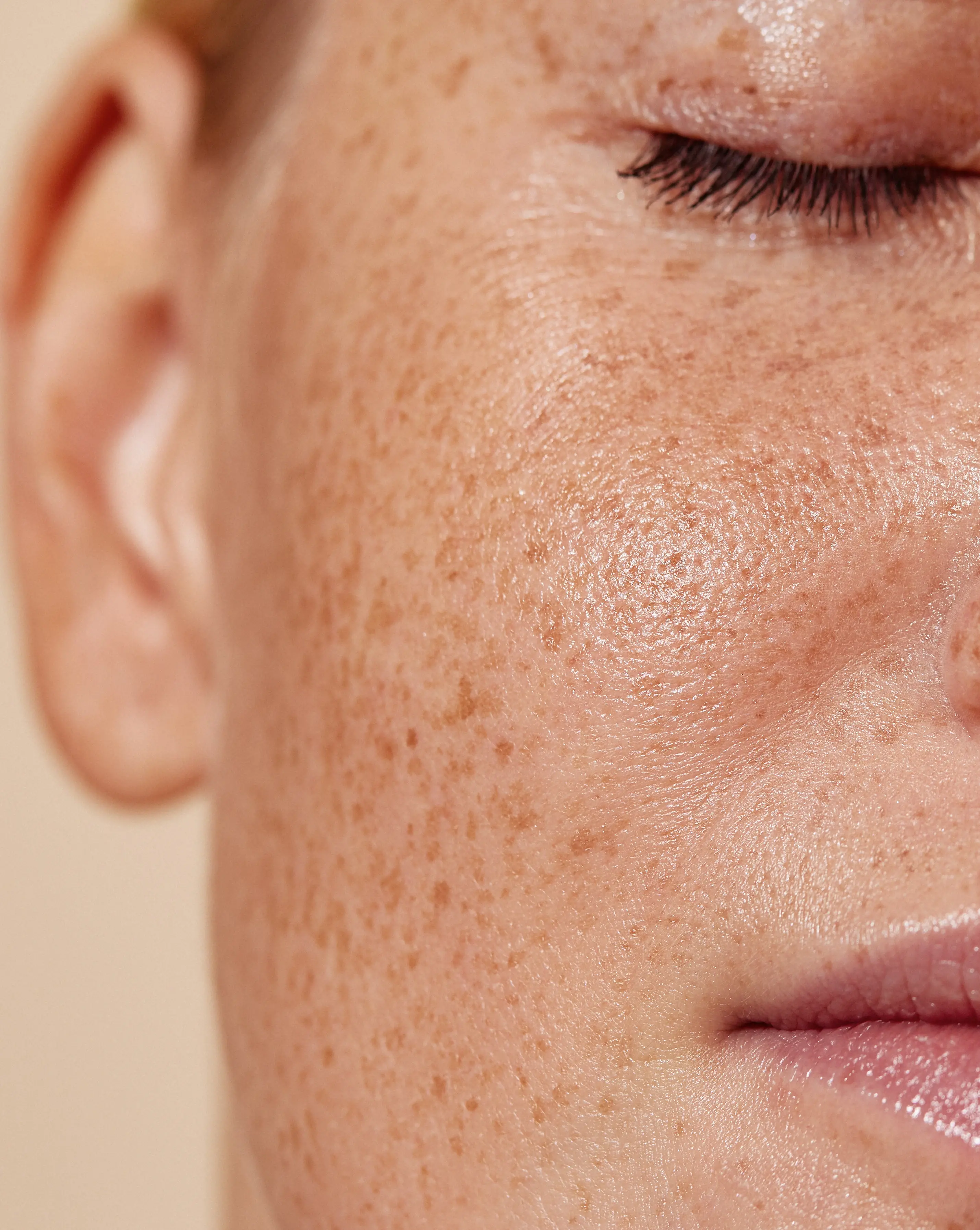 Pigmentflecken | aesthetics Pallas Kliniken Pigmentflecken